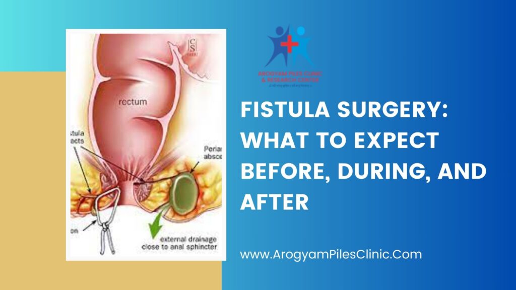 Fistula Surgery: What to Expect Before, During, and After