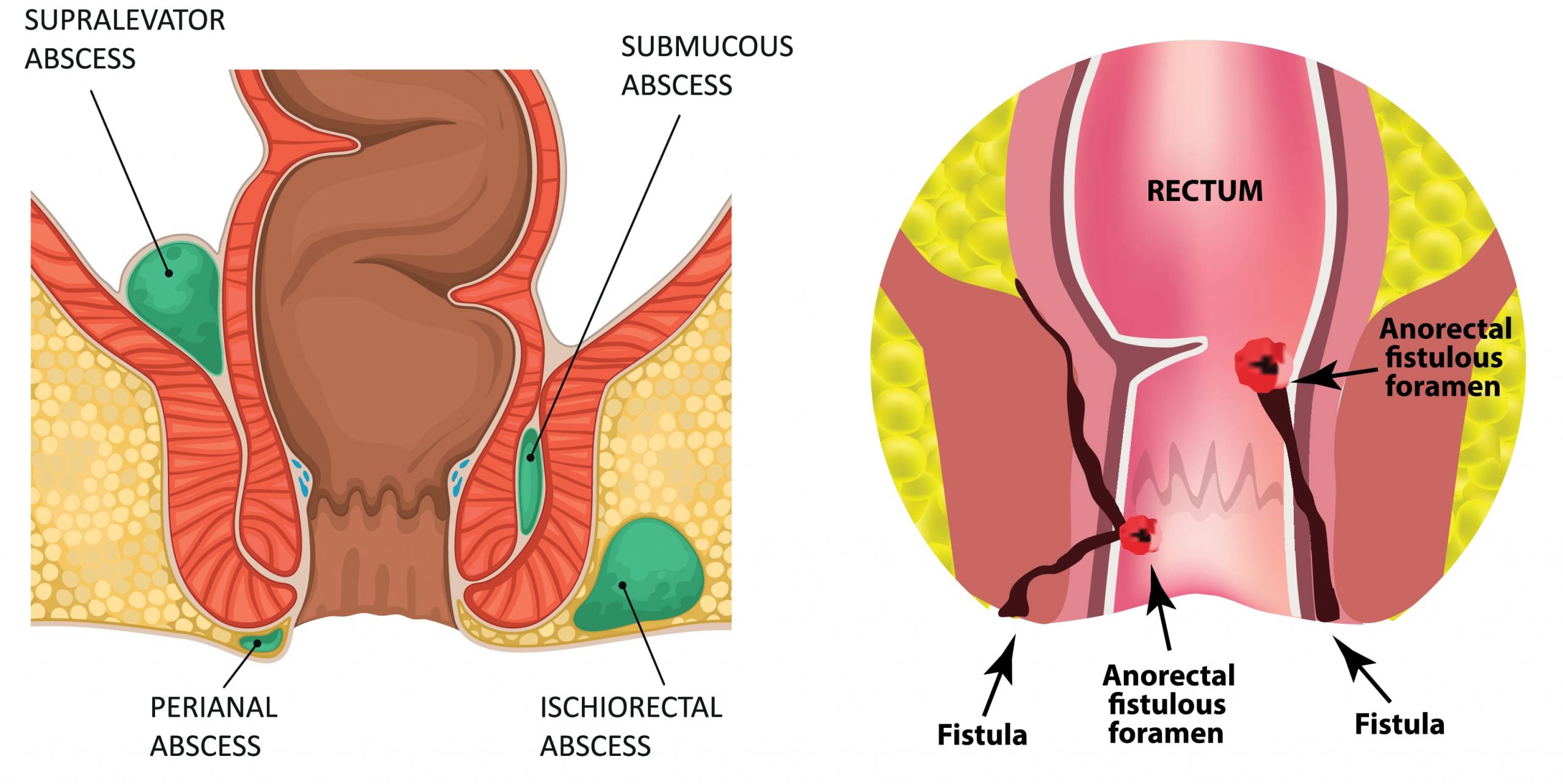 Exploring non-surgical options for fistula treatment