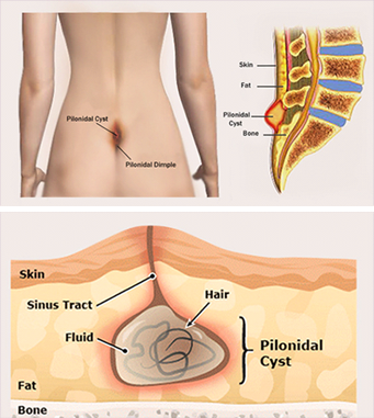 Pilonidal cyst or Pilonidal Sinus (PNS)