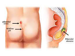 What happen if Pilonidal Sinus left untreated?/ Why should PILONIDAL SINUS is not to be left untreated? / complications of untreated pilonidal sinus.