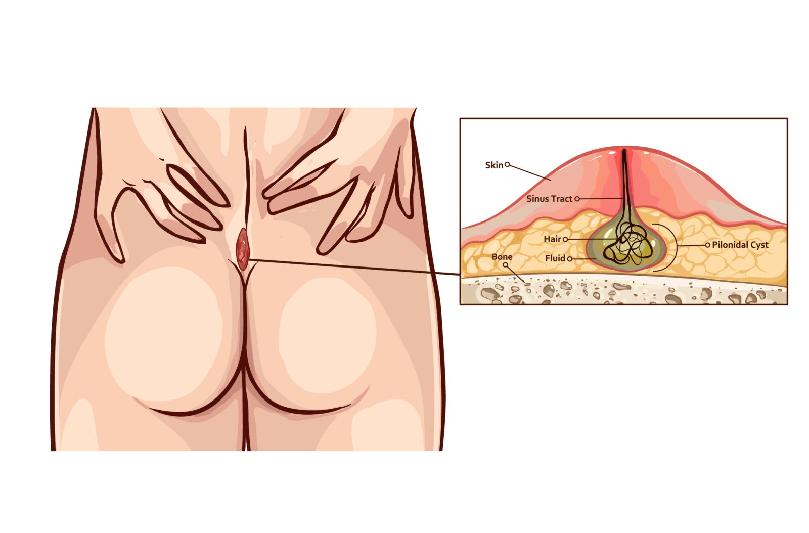 Pilonidal sinus (PNS) treatment in Chandigarh/ Pilonidal sinus treatment with ayurveda – kshar sutra/ Pilonidal sinus specialist doctor in Chandigarh/ Pilonidal sinus treatment without surgery in Chandigarh