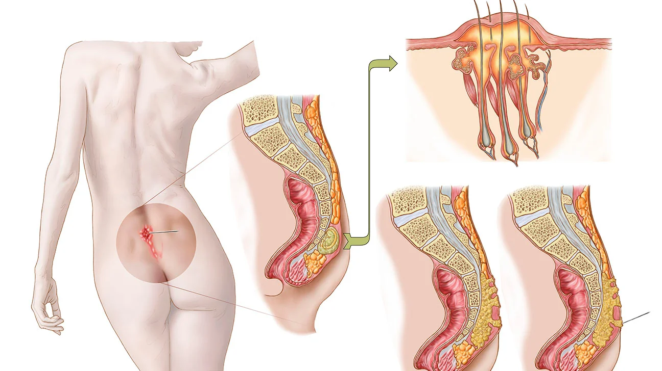 Pilonidal sinus (PNS) causes and prevention