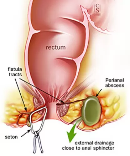 Understanding the importance and procedure of fistula surgery