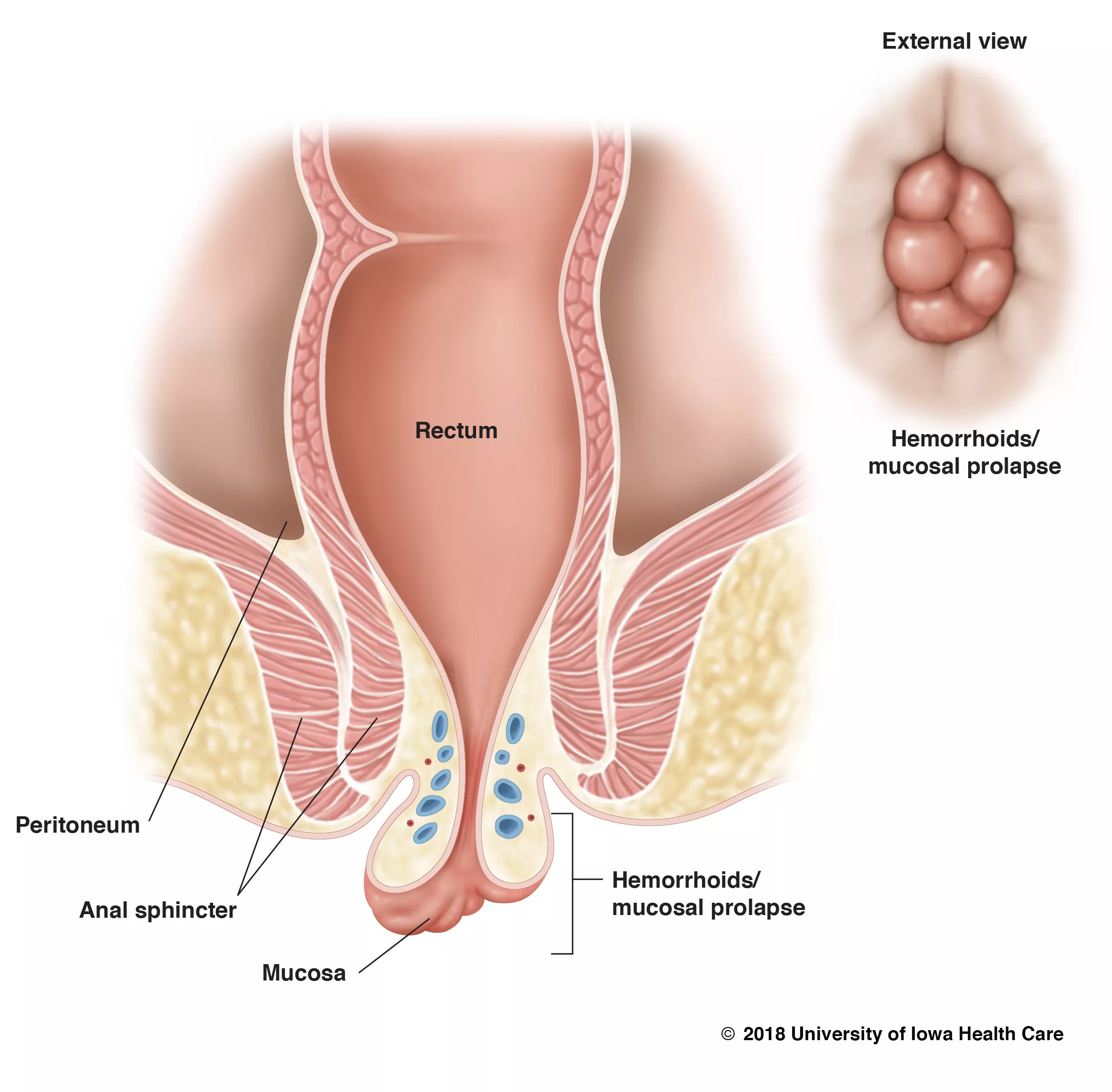 Finding the best piles specialist doctors in Chandigarh: your complete guide to piles treatment