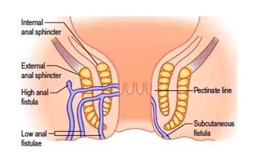 Understanding Fistula Surgery: Procedure, Recovery, and Risks