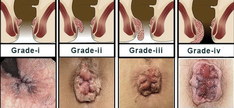 Innovative solutions: fistula treatment without surgery at Arogyam Piles Clinic