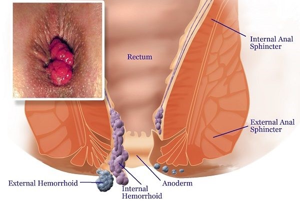 Understanding Piles Pain: Solutions from Arogyam Piles Clinic in Chandigarh